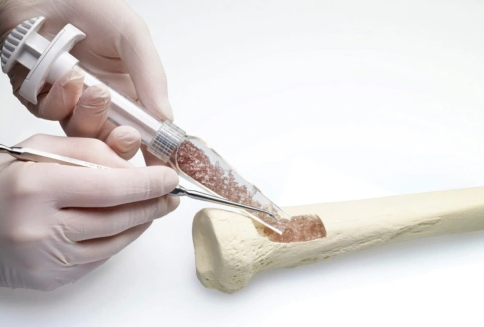 Scientists Develop Strong and Flexible Material for Bone Repair — «Искусственный костный наноматериал», близко повторяющий свойства человеческих костей, обеспечивает заживающему перелому стабильность / © Nature Communications (2025). DOI: 10.1038/s41467-025-59662-w