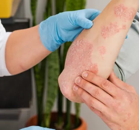 Beyond Injections: Will Johnson & Johnson’s New Psoriasis Pill Standardize Oral Therapy?