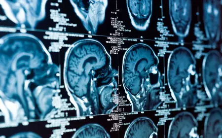 Alymlar ukysyzlygyndan soň  beýniniň “haýallandygyny” anykladylar